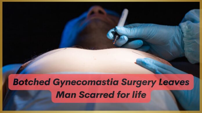 Botched Gynecomastia Surgery